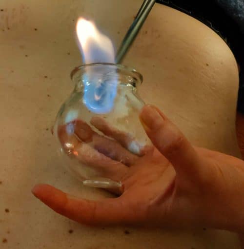 formation cupping therapy